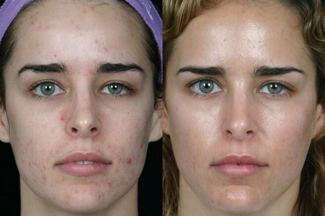 Broyage au laser de la peau du visage avant et après